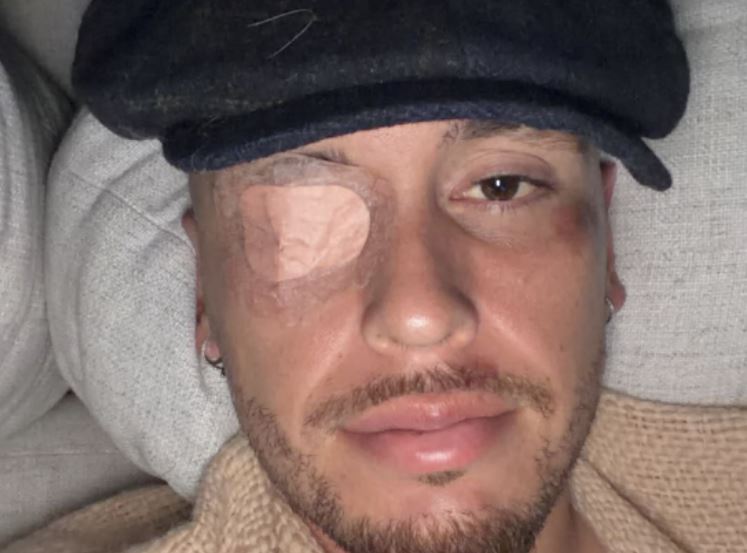 Lucas Ocampos con parálisis facial